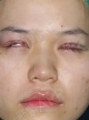 刚刚在来美安做完了上睑下垂手术请小伙伴要关注我啊