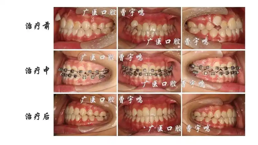 "小虎牙"的矫正_牙颌畸形_症状表现_治疗方式 - 好大夫在线