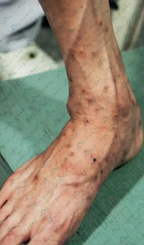 艾滋病人100%会出现的皮肤症状表现(详解) - 皮肤病学 - 天山医学院