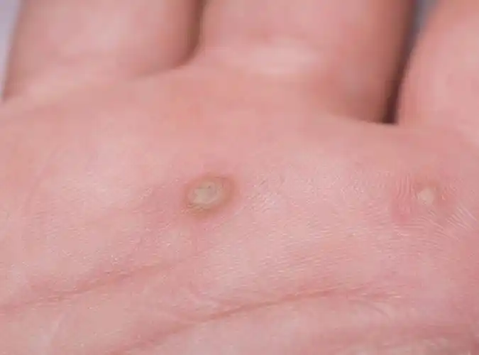 4,瘊子会传染复发,一定要防看完上文,我们知道了寻常疣能够传染,也