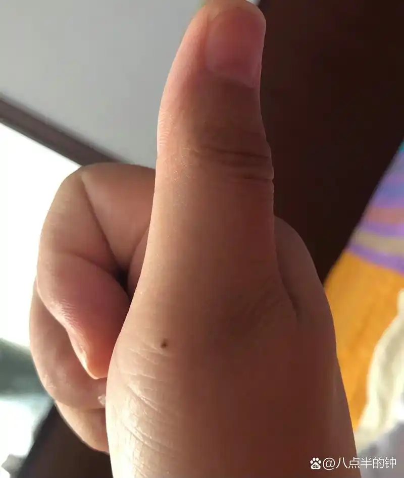 拇指长痣有什么含义吗? 左手右手都有的朋友,有木有?