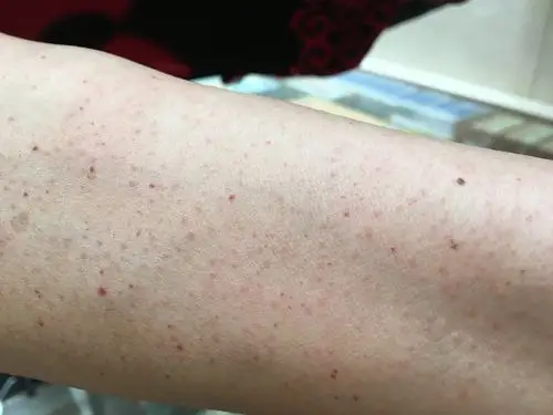 双上肢前臂红点(原创)