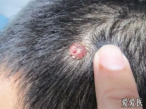 看图识病寻常疣