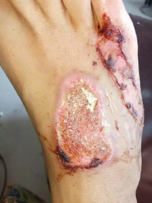 烫伤后结痂昨天把痂撕下来了现在伤口恢复怎么样?