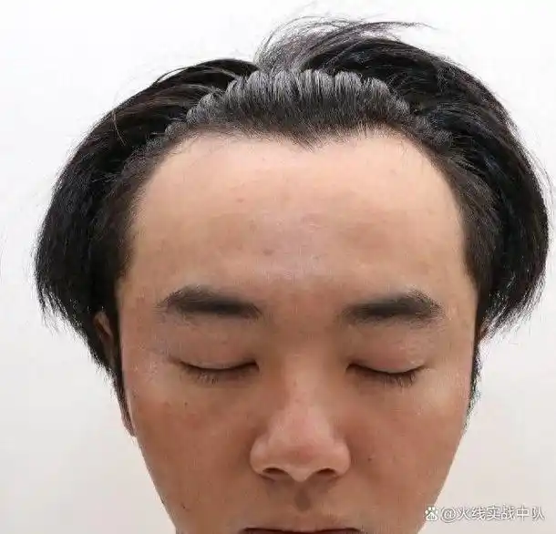 网友晒华晨宇的私人视频,贴出他整容,植发照片,怒骂张碧晨小三