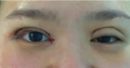 做双眼皮失败的图片