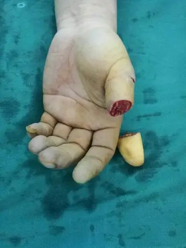 患者手指离断后到多家医院就诊后来我院就诊!