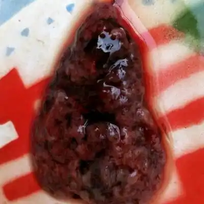 自然流产流出这样的是葡萄胎吗