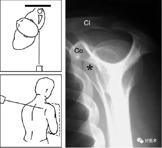 肩痛康复肩关节损伤影像诊断技巧