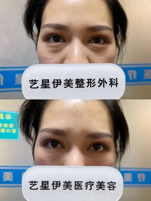 一支就见效那种04丰泪沟～_嗨体_熊猫_廊坊艺星伊美医疗美容自由行