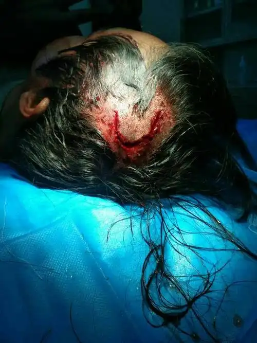 请问在工地上头部受伤,伤口长十多厘米,能索赔多少