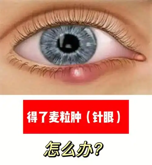 得了麦粒肿针眼如何快速消褪
