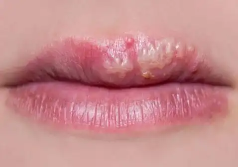 女人艾滋病的三大阶段症状及早期症状图片