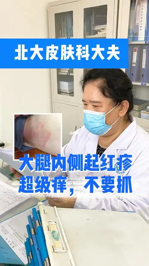 40年皮肤科经验男生易犯的股癣要这样治疗