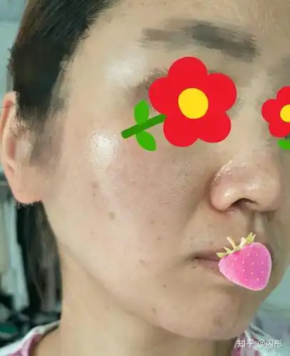 油性痘痘肌适合用什么防晒霜?