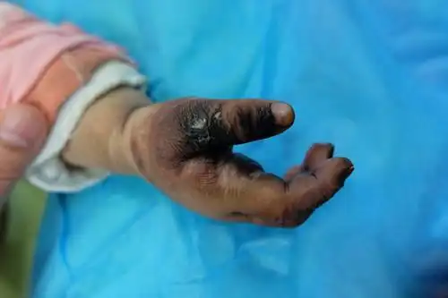 2岁宝宝在家竟因这截肢,血泪教训啊!