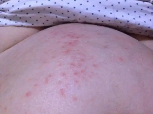 孕妇身上老是痒咋回事?