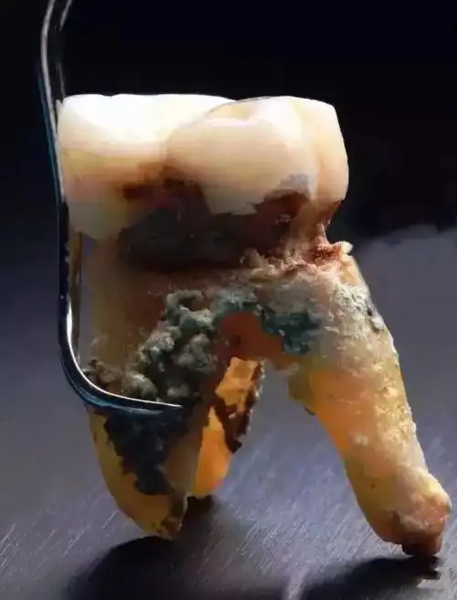 【科普知识】坏牙是拔?是留?_牙齿