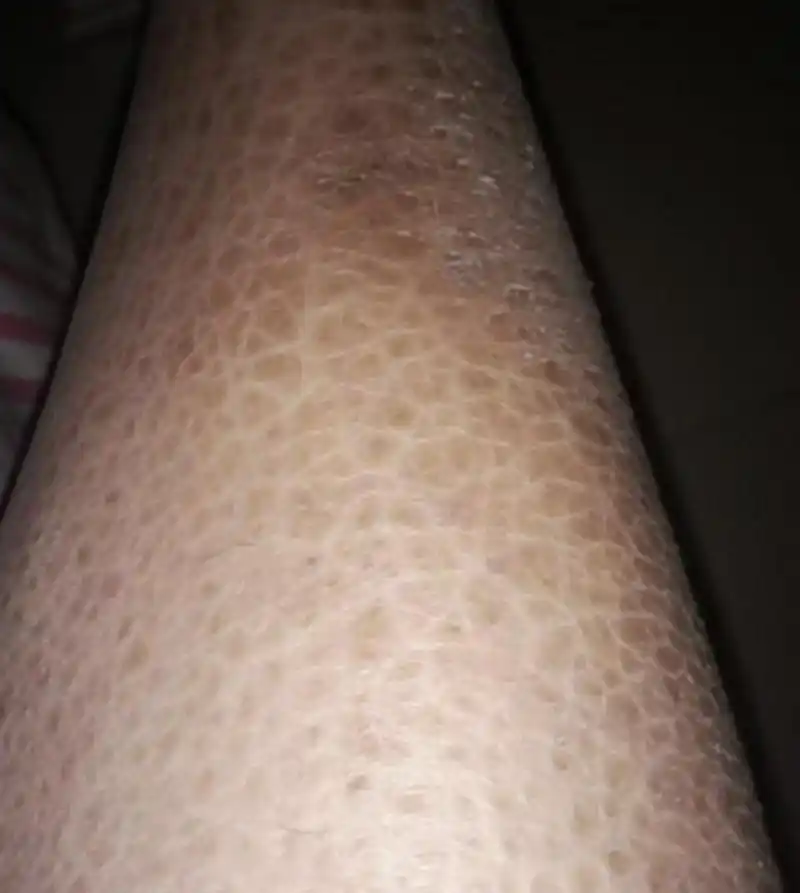 朋友腿上这样了,告诉我这是鱼鳞病,这病好治吗?