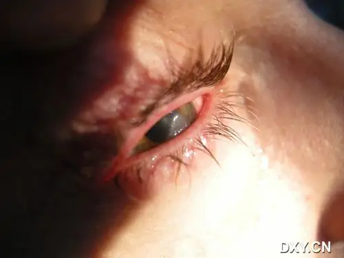 求助一角膜溃疡的诊治. [病例帖]