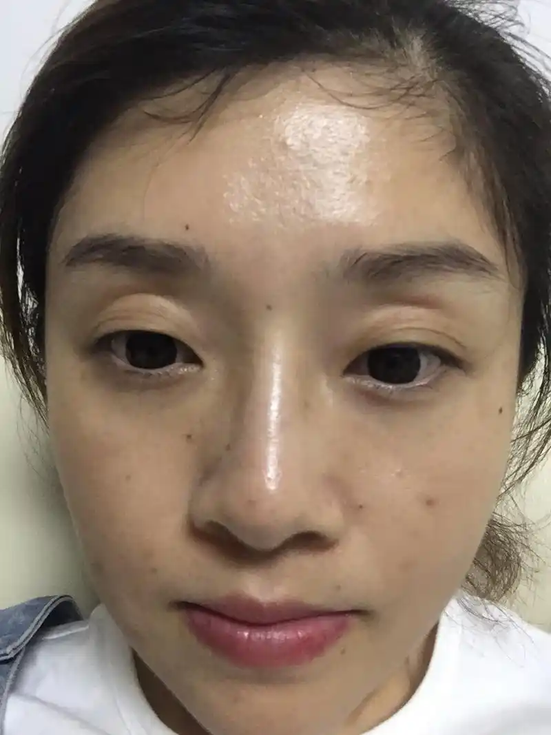 关于眼窝凹陷自体脂肪填充的心路历程