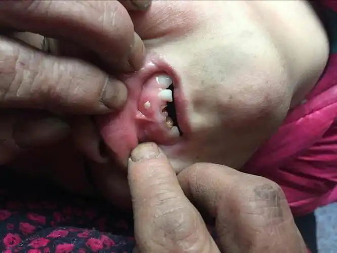 六岁小孩牙龈上长牙齿请问该怎么治疗