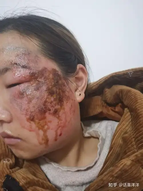 热油烫伤面部记录