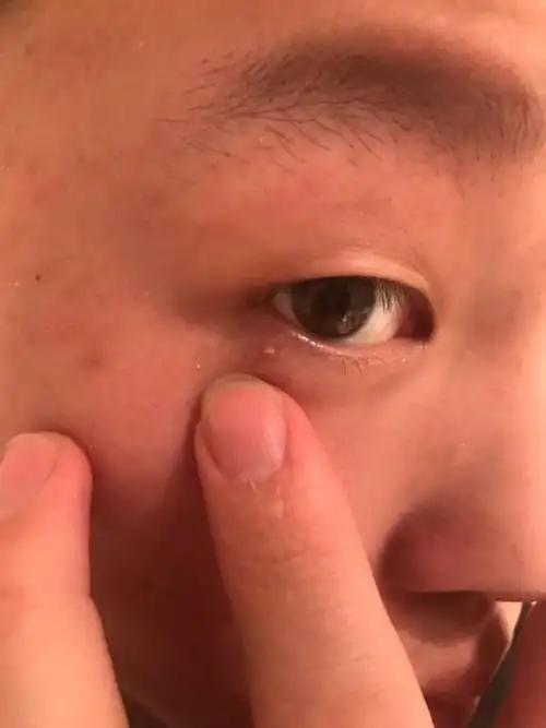 眼睛旁边长了一颗肉粒,不痛不痒,越来越大