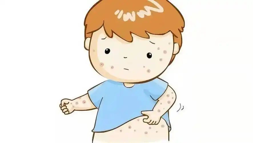 泛发性湿疹是一种慢性皮肤病,其主要特征是皮肤红肿,瘙痒,脱屑和潮湿.