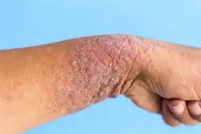 男性手臂湿疹图片