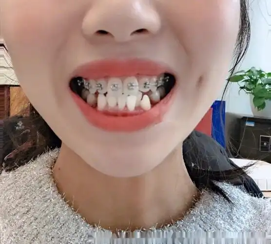 矫正前的牙齿简直不忍直视龅牙虎牙外加不齐的下牙