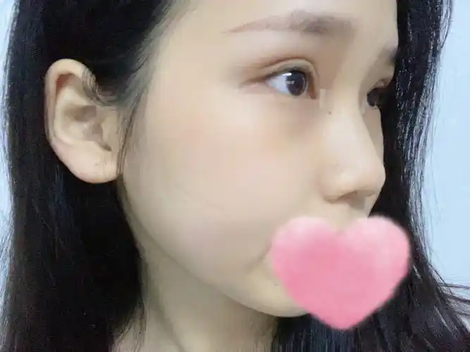 全切77开眼角双眼皮第25天