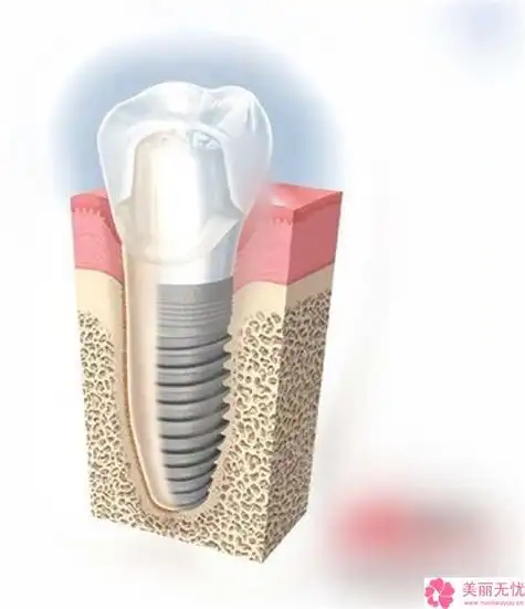丽江市瑞士拓美thommen种植牙医生排名榜靠谱权威丽江市瑞士拓美