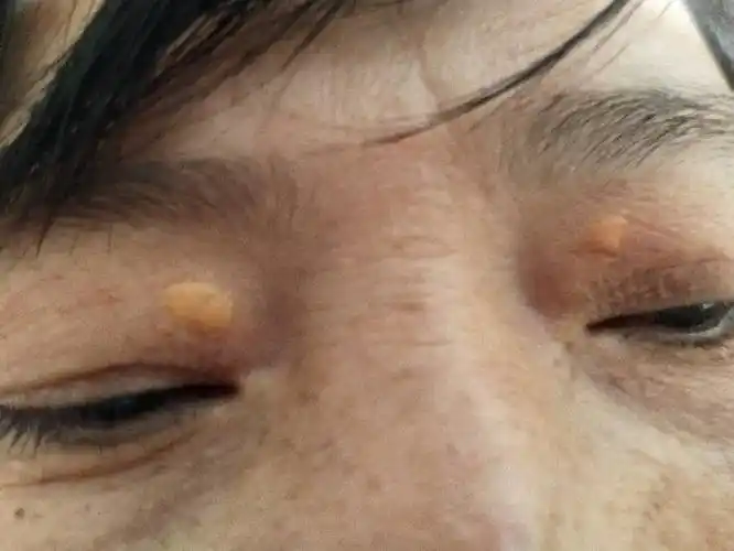 我妈眼皮上长了肉疙瘩,不会痛的,前年开始出现,请问下这是什么,需要管