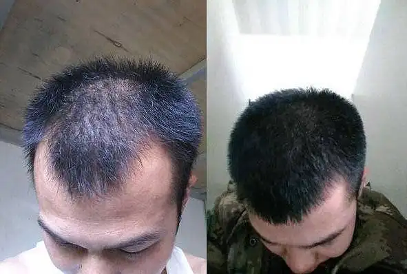 男性脱发严重怎么办这些方法能快速生发