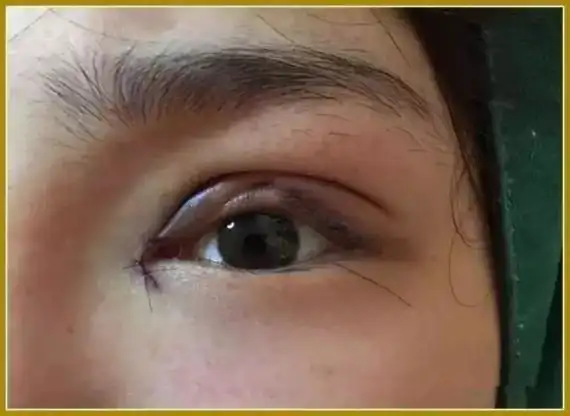 双眼皮手术后,睁眼费力或伴有上睑下垂,有沉着不适感.