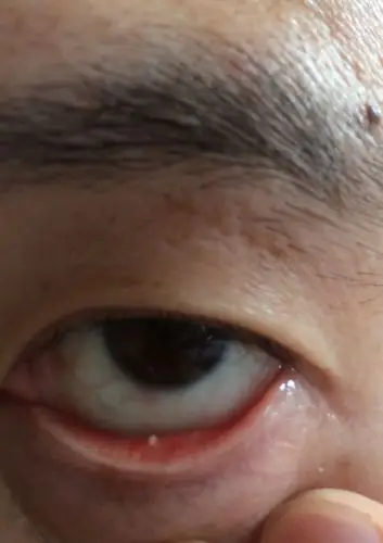 下眼皮 有一个白色不明物,是什么?好久了要紧吗?