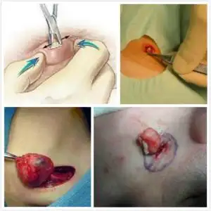 搞定粉瘤,套路不用很深