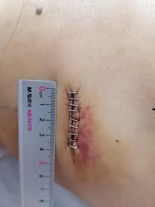 小切口解决大问题——邵东人医胸外科自主独立开展首