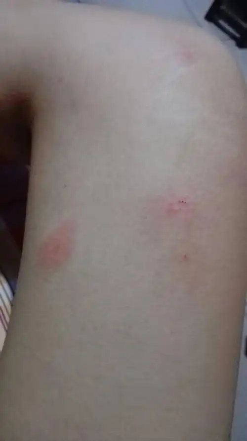 懂得人告诉我这是什么,外面红晕,里面是小红点,微痒