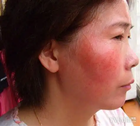 脸部皮肤过敏红肿_脸部皮肤过敏红肿痒_淘宝助理