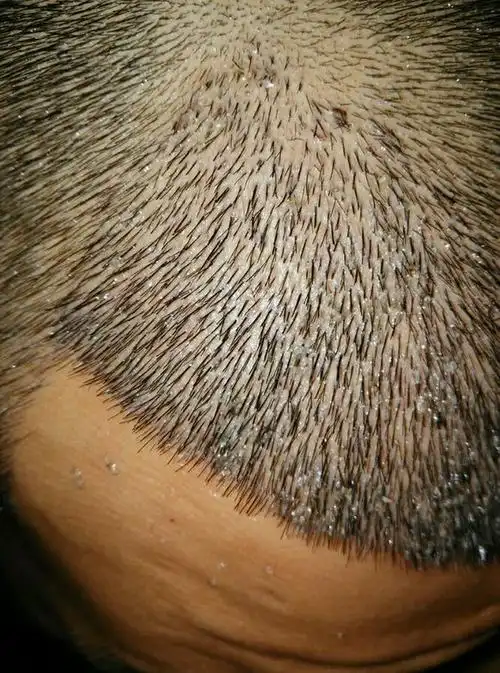 第八天头皮上全是血痂,还不好清理