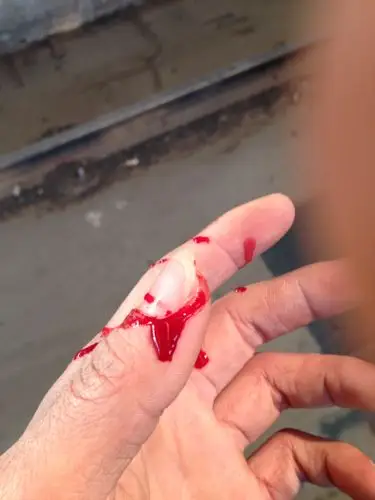 为什么我手烂个小伤口就会流很多血?