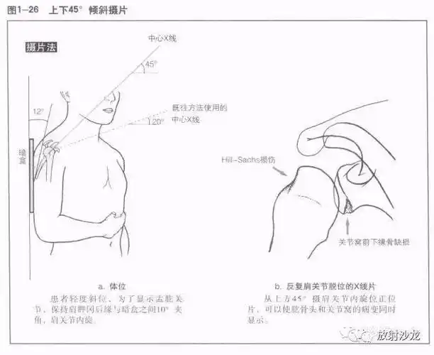 4 5 肩关节x线解读 (1)锁骨的x线解剖在后前位x线片上,长管状的锁骨