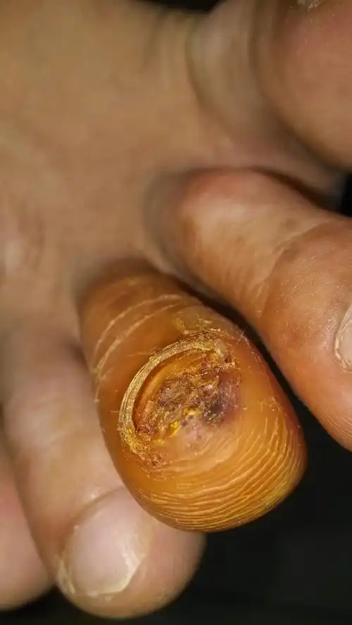 各位医生这个到底要多久啊,两周前把指甲踢掉了