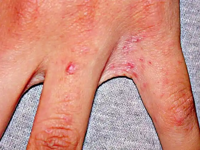 医生信箱痕痒难熬的疥疮