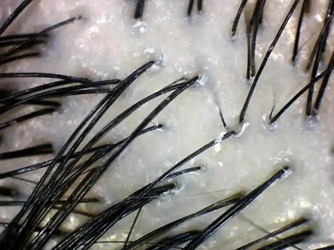 图一二为干性头皮治疗前后