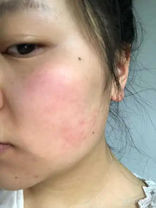 敏感肌肤怎么养护呢?总是发红过敏,不知道如何是好了?