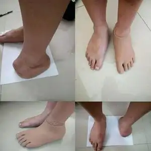 碳纤维脚假肢