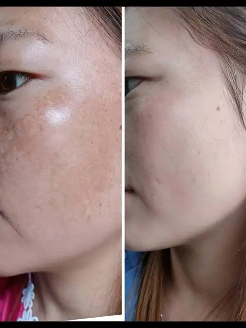 改善斑点前后对比脸干净就是自信
